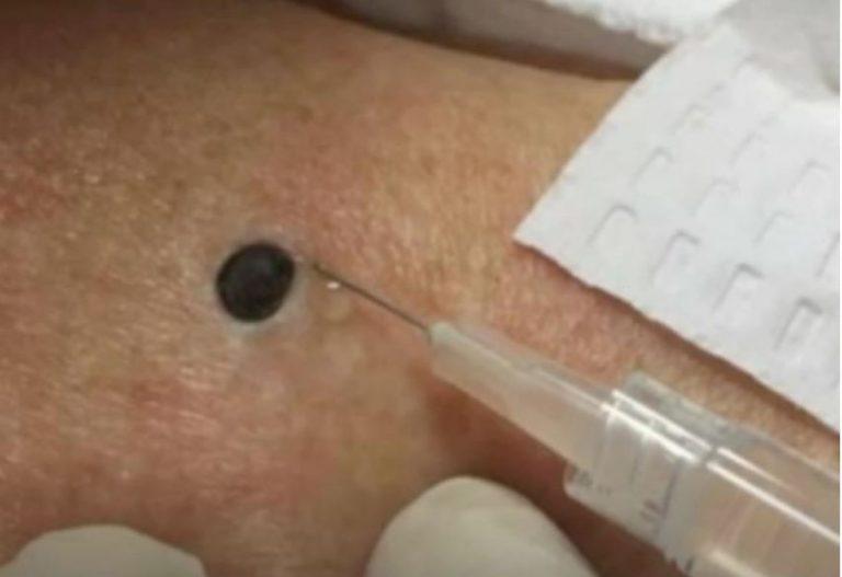 “Zeni je ovo stojalo na ledjima godinama- Kada je doktorica uzela spricu i bocnula svi su zaledjeni ostali.” SNIMAK pregledan 33 miliona puta - featured image “Zeni je ovo stojalo na ledjima godinama- Kada je doktorica uzela spricu i bocnula svi su zaledjeni ostali.” SNIMAK pregledan 33 miliona puta - featured image