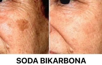 SODA BIKARBONA uklanja STARAČKE MRLJE! Ovo morate napraviti… SODA BIKARBONA uklanja STARAČKE MRLJE! Ovo morate napraviti… - featured image