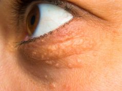 STAVILA SAM OVU NAMIRNICU NA MASNO TKIVO KOD OKA, ono je preko noći nestalo: EVO ŠTA ME SPASILO, SVI GA IMATE U KUĆI