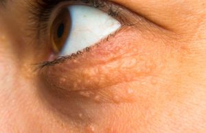 STAVILA SAM OVU NAMIRNICU NA MASNO TKIVO KOD OKA, ono je preko noći nestalo: EVO ŠTA ME SPASILO, SVI GA IMATE U KUĆI