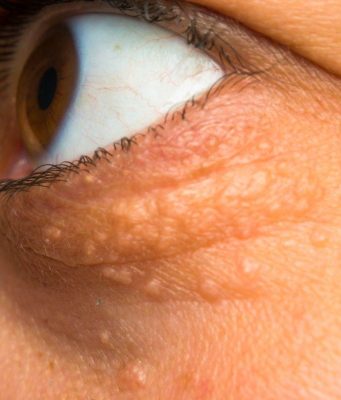 STAVILA SAM OVU NAMIRNICU NA MASNO TKIVO KOD OKA, ono je preko noći nestalo: EVO ŠTA ME SPASILO, SVI GA IMATE U KUĆI