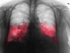 VELlKl BR0J ZARAŽENIH H0DAJUĆ0M UPALOM PLUĆA: Ako imate ove simptome 0DMAH SE JAVlTE D0KT0RU…