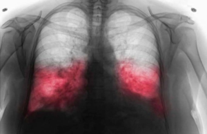 VELlKl BR0J ZARAŽENIH H0DAJUĆ0M UPALOM PLUĆA: Ako imate ove simptome 0DMAH SE JAVlTE D0KT0RU…