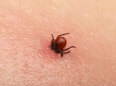 Bezbolno je i nema čupanja: Doktorka otkrila trik kako da se krpelj sam otkači sa kože (video) Bezbolno je i nema čupanja: Doktorka otkrila trik kako da se krpelj sam otkači sa kože (video) - featured image