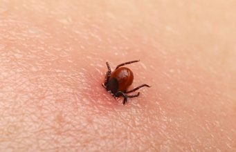 Bezbolno je i nema čupanja: Doktorka otkrila trik kako da se krpelj sam otkači sa kože (video) Bezbolno je i nema čupanja: Doktorka otkrila trik kako da se krpelj sam otkači sa kože (video) - featured image