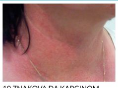 10 ZNAKOVA DA KARCINOM RASTE U VAŠEM TIJELU: Ovo su rani znakovi raka, broj 3 mnogi zanemaruju 10 ZNAKOVA DA KARCINOM RASTE U VAŠEM TIJELU: Ovo su rani znakovi raka, broj 3 mnogi zanemaruju - featured image