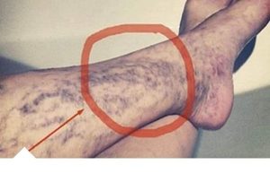 Svatko kod kuće ima lijek za popucale kapilare, ali mnogi ljudi to ne znaju! Svatko kod kuće ima lijek za popucale kapilare, ali mnogi ljudi to ne znaju! - featured image