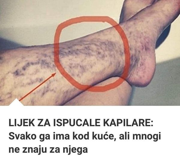 Svatko kod kuće ima lijek za popucale kapilare, ali mnogi ljudi to ne znaju! - featured image