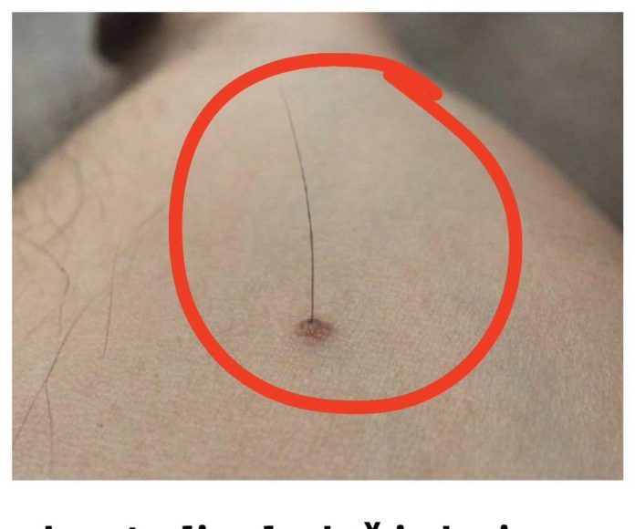Evo šta tačno znači kada vam iz mladeža raste dlaka: Da li je to opasno, iznenadit ćete se - featured image