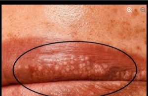 Bele fleke na usnama ili intimnom području? Ne ignorišite ove znake upozorenja! Bele fleke na usnama ili intimnom području? Ne ignorišite ove znake upozorenja! - featured image