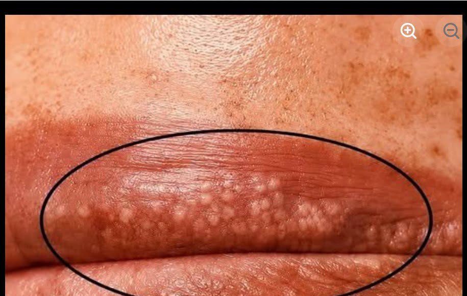 Bele fleke na usnama ili intimnom području? Ne ignorišite ove znake upozorenja! - featured image