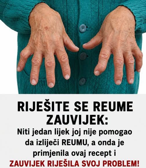 RIJEŠITE SE REUME ZAUVIJEK: Niti jedan lijek joj nije pomogao da izliječi REUMU, a onda je primjenila ovaj recept i ZAUVIJEK riješila svoj problem! - featured image RIJEŠITE SE REUME ZAUVIJEK: Niti jedan lijek joj nije pomogao da izliječi REUMU, a onda je primjenila ovaj recept i ZAUVIJEK riješila svoj problem! - featured image