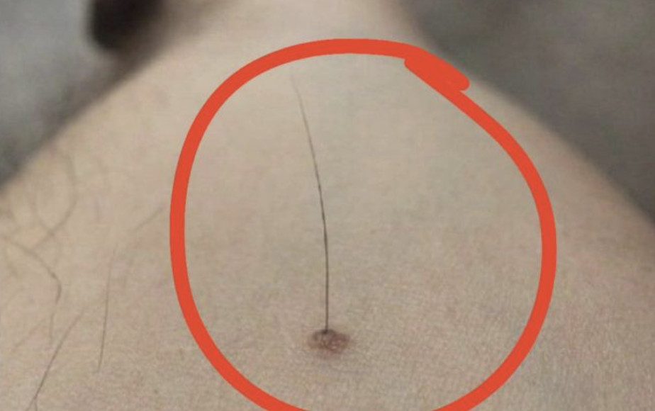 Evo šta tačno znači kada vam iz mladeža raste dlaka: Da li je to opasno, iznenadit ćete se - featured image Evo šta tačno znači kada vam iz mladeža raste dlaka: Da li je to opasno, iznenadit ćete se - featured image