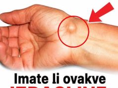 IMATE LI OVAKVE IZRASLINE: Evo kako da ih se riješite PREKO NOĆI IMATE LI OVAKVE IZRASLINE: Evo kako da ih se riješite PREKO NOĆI - featured image