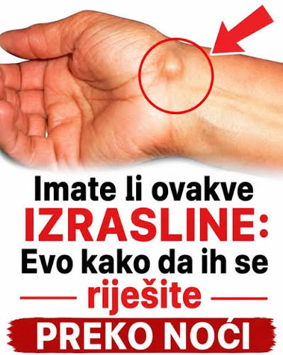 IMATE LI OVAKVE IZRASLINE: Evo kako da ih se riješite PREKO NOĆI - featured image