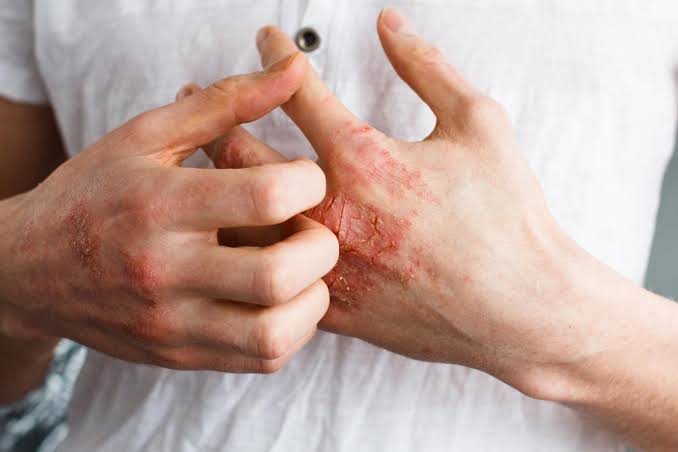Umor, svrab, VISOK KRVNI PRITISAK, BOL U LEĐIMA – Ova bolest je ”TIHI UBICA”, obratite pažnju ako imate neke od ovih simptoma - featured image