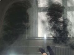 OVO JE PRVI SIMPTOM RAKA PLUĆA, A NIJE KAŠALJ: Većina ljudi ga nikad ne poveže sa ovom opakom bolešću! OVO JE PRVI SIMPTOM RAKA PLUĆA, A NIJE KAŠALJ: Većina ljudi ga nikad ne poveže sa ovom opakom bolešću! - featured image