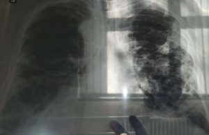 OVO JE PRVI SIMPTOM RAKA PLUĆA, A NIJE KAŠALJ: Većina ljudi ga nikad ne poveže sa ovom opakom bolešću! OVO JE PRVI SIMPTOM RAKA PLUĆA, A NIJE KAŠALJ: Većina ljudi ga nikad ne poveže sa ovom opakom bolešću! - featured image