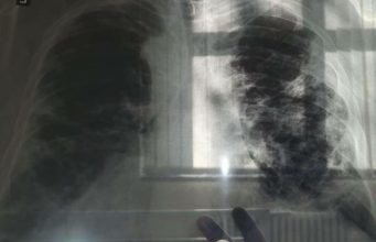 OVO JE PRVI SIMPTOM RAKA PLUĆA, A NIJE KAŠALJ: Većina ljudi ga nikad ne poveže sa ovom opakom bolešću! OVO JE PRVI SIMPTOM RAKA PLUĆA, A NIJE KAŠALJ: Većina ljudi ga nikad ne poveže sa ovom opakom bolešću! - featured image