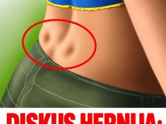 DISKUS HERNIJA: Ovaj DOMAĆI LIJEK potpuno OBNAVLJA KIČMU, JAČA JE I LIJEČI DISKUS HERNIJA: Ovaj DOMAĆI LIJEK potpuno OBNAVLJA KIČMU, JAČA JE I LIJEČI - featured image