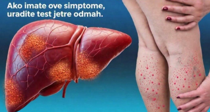 DA LI JE VAŠA JETRA U OPASNOSTI? Ovo je 12 ranih znakova ciroze jetre koje ne smete da ignorišete - featured image DA LI JE VAŠA JETRA U OPASNOSTI? Ovo je 12 ranih znakova ciroze jetre koje ne smete da ignorišete - featured image