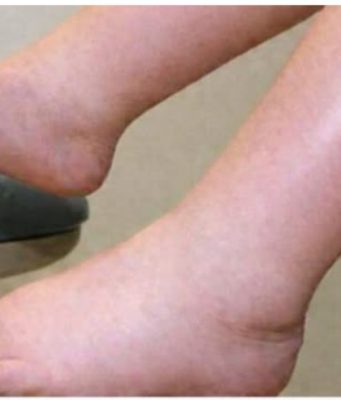 DA IZBACITE VIŠAK VODE POTREBAN VAM JE JEDAN VITAMIN: Ni noge vam više neće oticati, samo ga ubacite u ishranu DA IZBACITE VIŠAK VODE POTREBAN VAM JE JEDAN VITAMIN: Ni noge vam više neće oticati, samo ga ubacite u ishranu - featured image