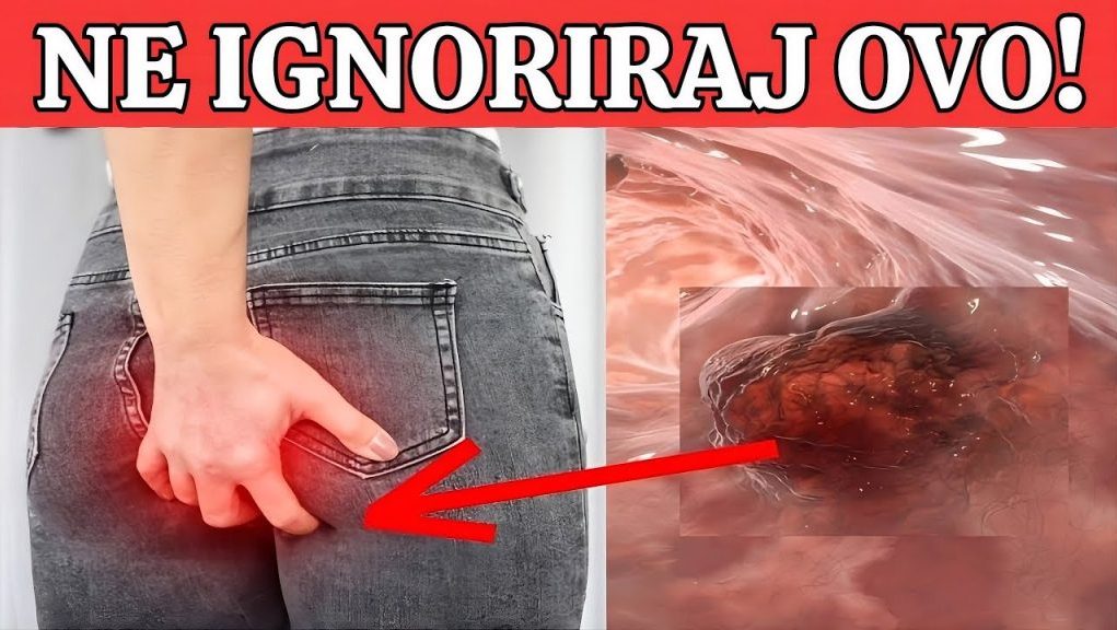 R@k debelog crijeva! UpozoravajućI znakovi I simptomi koje nikada ne smijete ignorirati. - featured image
