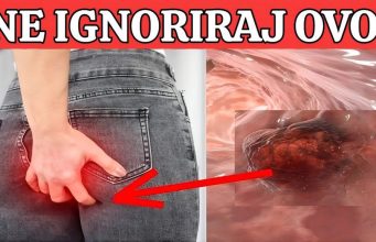 R@k debelog crijeva! UpozoravajućI znakovi I simptomi koje nikada ne smijete ignorirati. R@k debelog crijeva! UpozoravajućI znakovi I simptomi koje nikada ne smijete ignorirati. - featured image