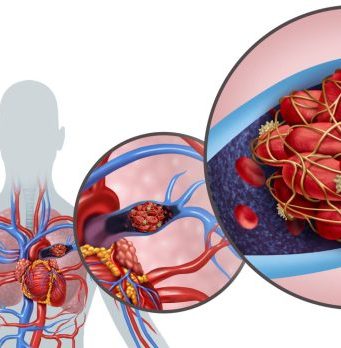 PLUĆNA EMBOLIJA JE VEĆI UZROK SMRTI OD INFARKTA! Dr Seferović otkriva: “Glavni simptom se vidi na nozi” PLUĆNA EMBOLIJA JE VEĆI UZROK SMRTI OD INFARKTA! Dr Seferović otkriva: “Glavni simptom se vidi na nozi” - featured image
